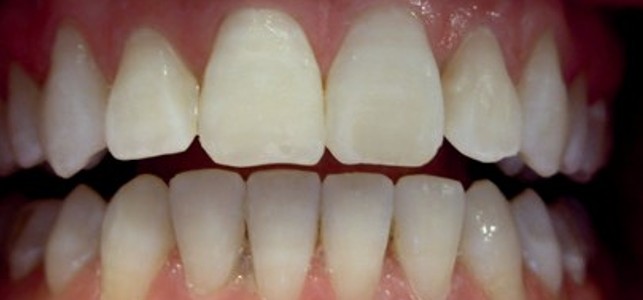 Camouflage of a fluorotic change in the enamel with superimposed post-orthodontic decalcifications